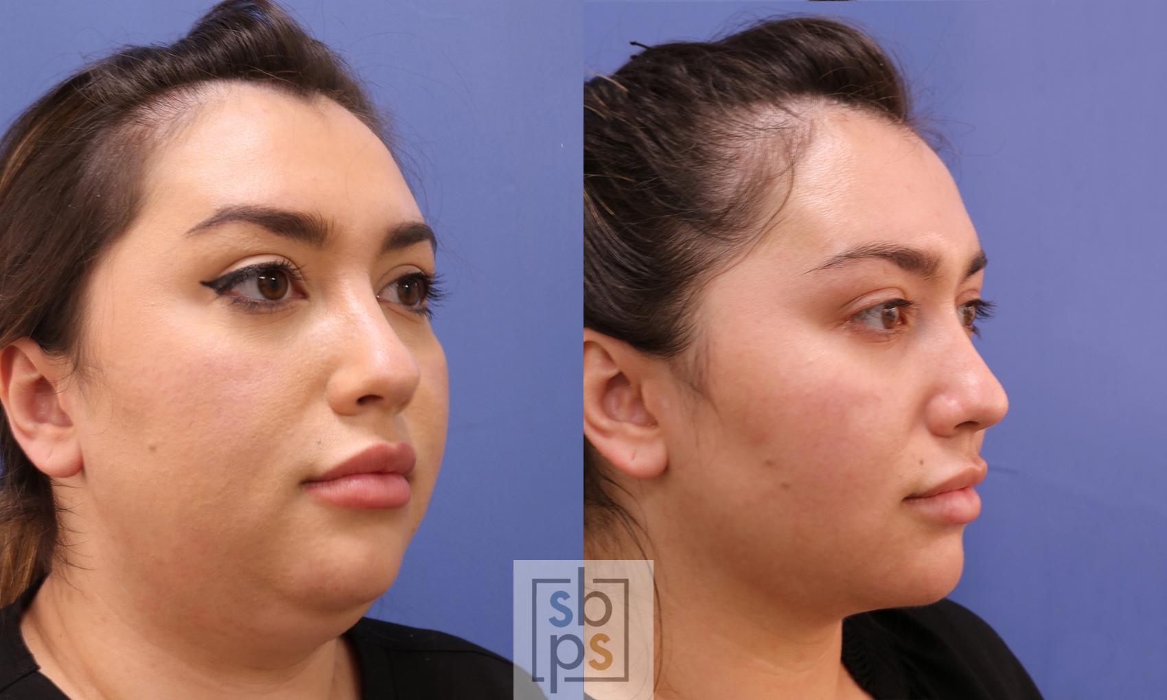 Before & After Chin Liposuction Case 472 Right Oblique View in Torrance & Los Angeles, CA, CA