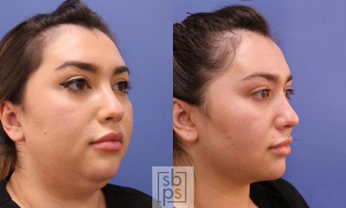 Before & After Chin Liposuction Case 472 Right Oblique View in Torrance, CA