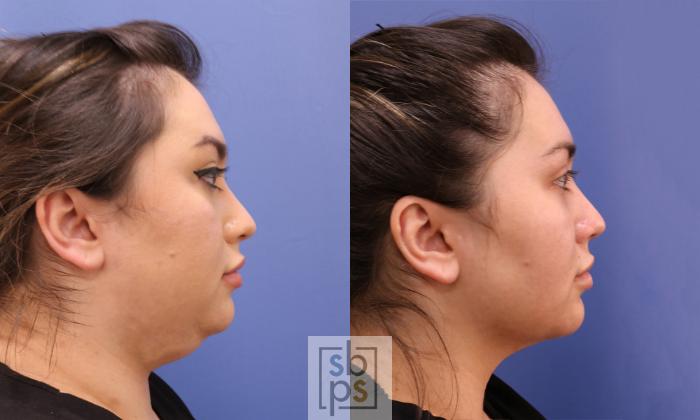 Before & After Chin Liposuction Case 472 Right Side View in Torrance, CA