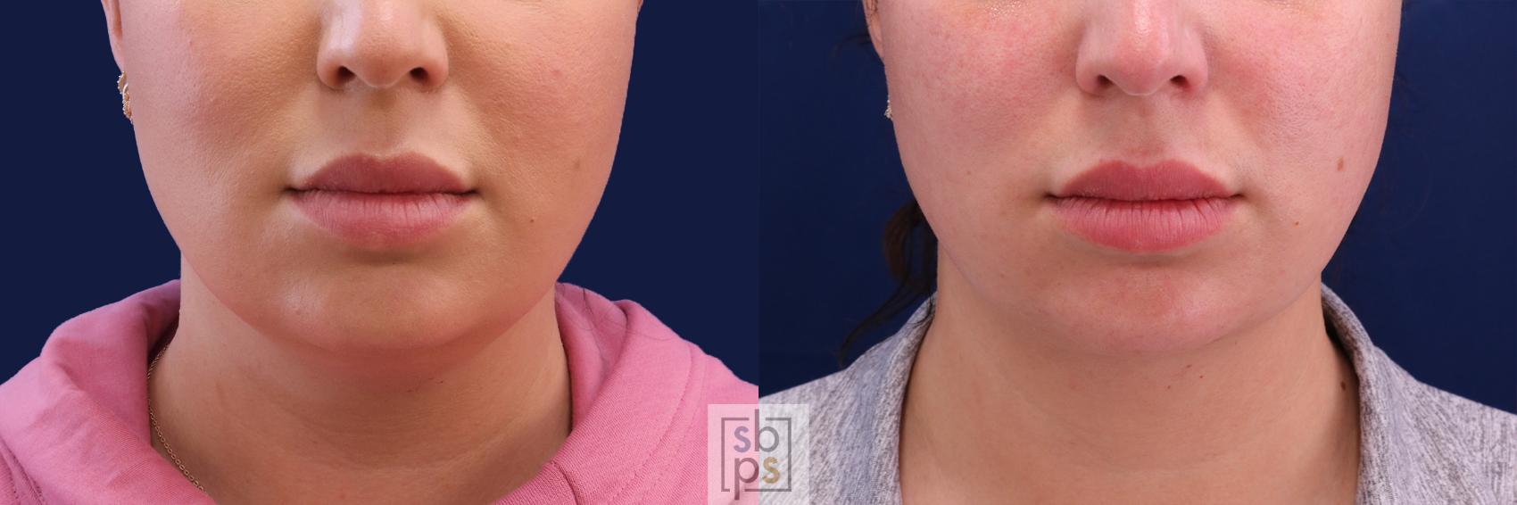Before & After Chin Liposuction Case 480 Front View in Torrance, CA