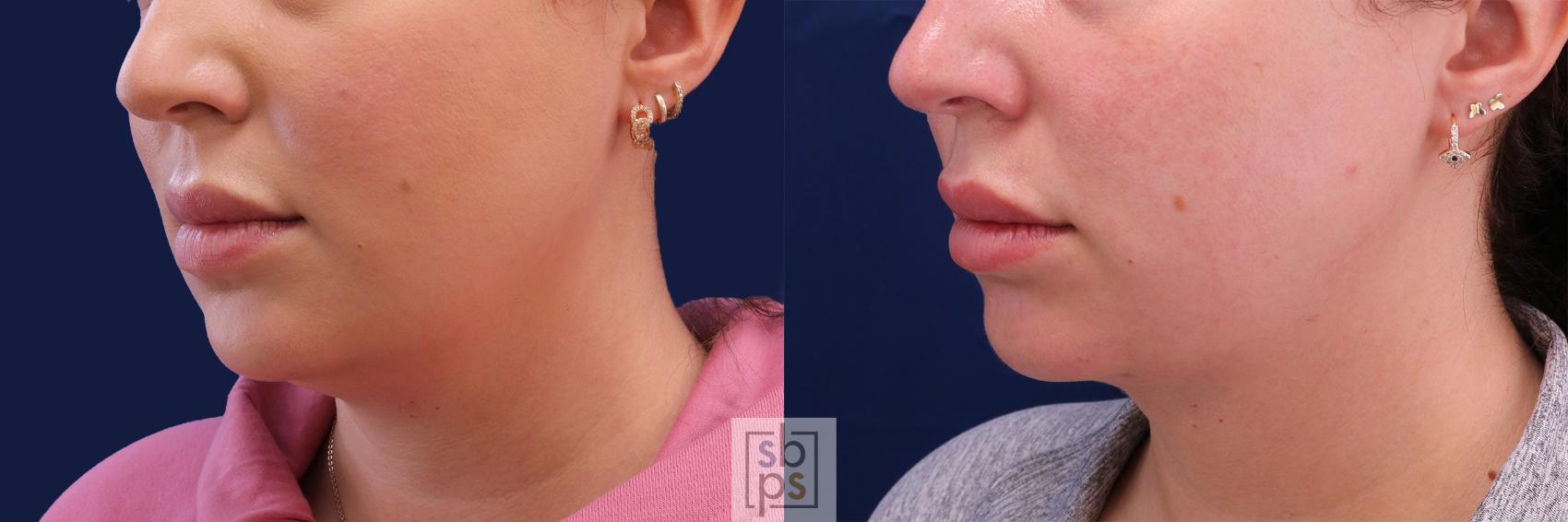 Before & After Chin Liposuction Case 480 Left Oblique View in Torrance & Los Angeles, CA, CA