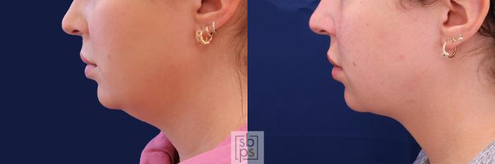 Before & After Chin Liposuction Case 480 Left Side View in Torrance, CA