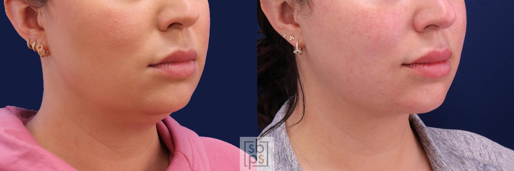 Before & After Chin Liposuction Case 480 Right Oblique View in Torrance & Los Angeles, CA, CA