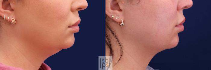 Before & After Chin Liposuction Case 480 Right Side View in Torrance, CA