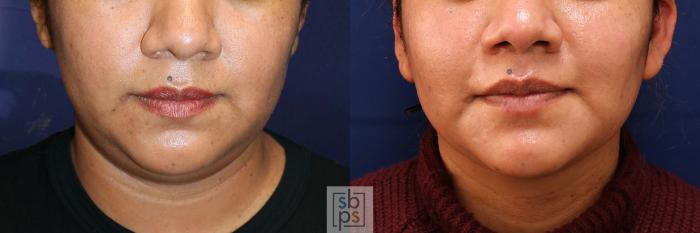 Before & After Chin Liposuction Case 532 Front View in Torrance, CA