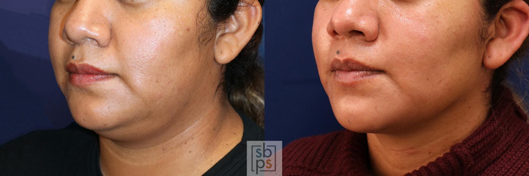 Before & After Chin Liposuction Case 532 Left Oblique View in Torrance & Los Angeles, CA, CA