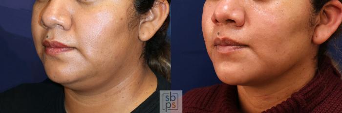 Before & After Chin Liposuction Case 532 Left Oblique View in Torrance, CA