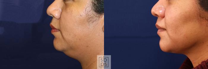 Before & After Chin Liposuction Case 532 Left Side View in Torrance, CA