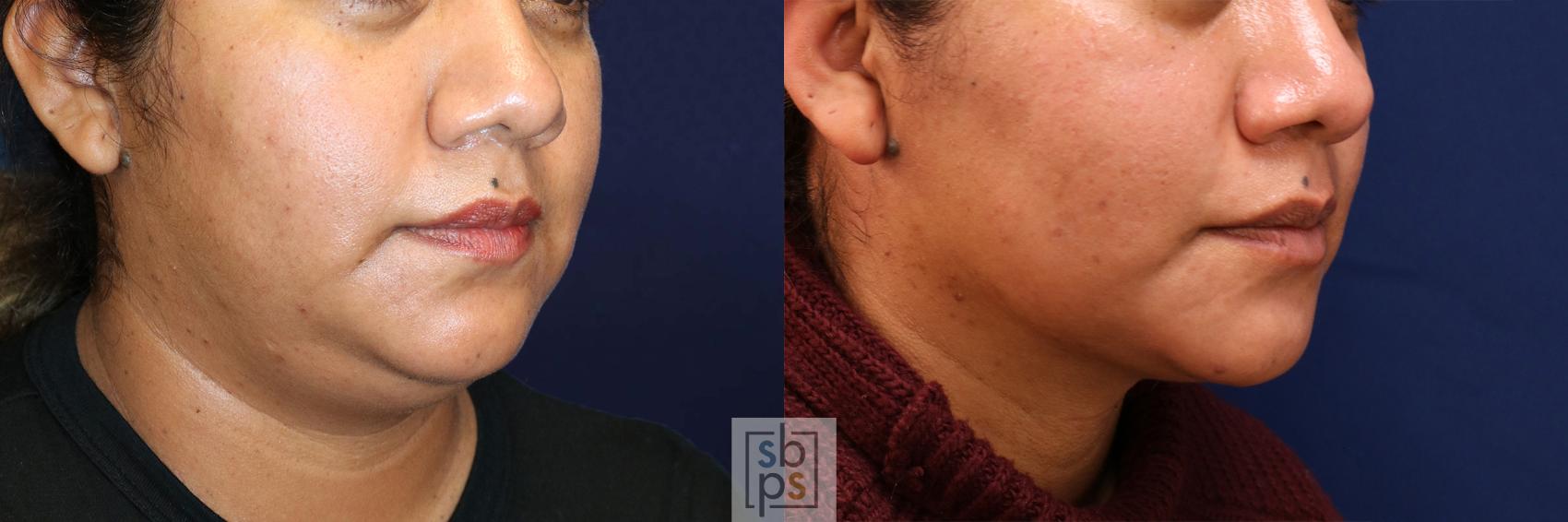 Before & After Chin Liposuction Case 532 Right Oblique View in Torrance & Los Angeles, CA, CA