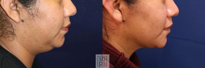 Before & After Chin Liposuction Case 532 Right Side View in Torrance, CA