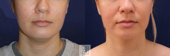 Before & After Chin Liposuction Case 548 Front View in Torrance, CA