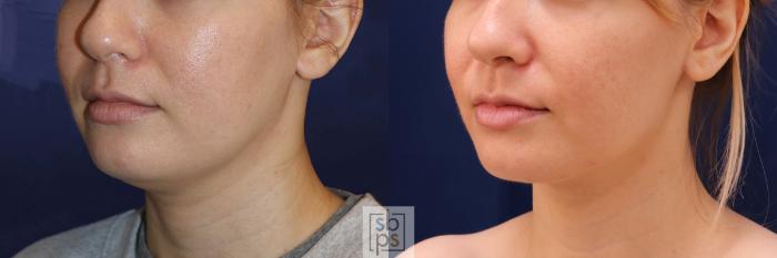 Before & After Chin Liposuction Case 548 Left Oblique View in Torrance, CA