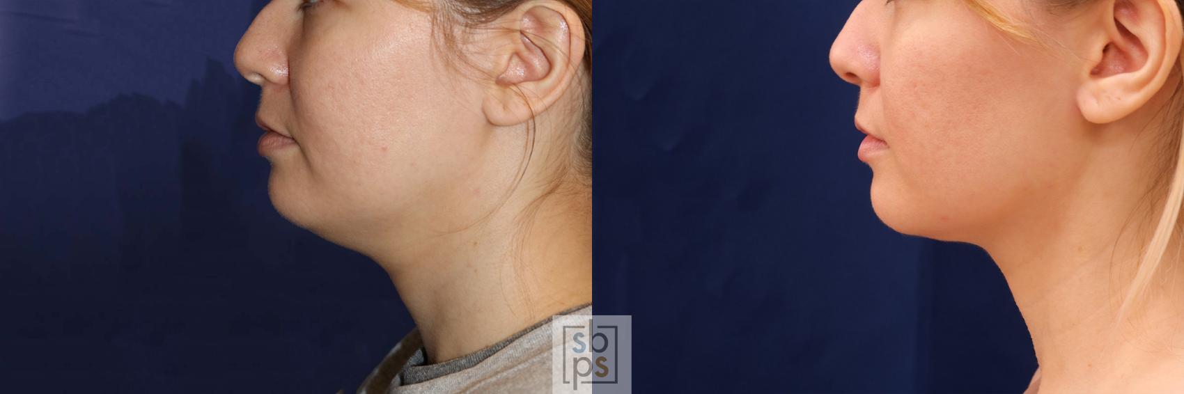 Before & After Chin Liposuction Case 548 Left Side View in Torrance & Los Angeles, CA, CA