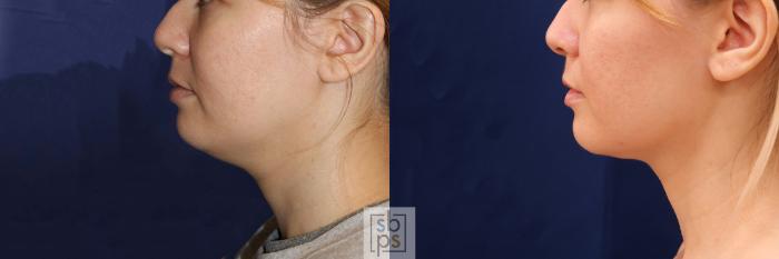 Before & After Chin Liposuction Case 548 Left Side View in Torrance, CA