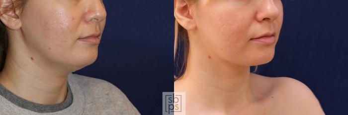 Before & After Chin Liposuction Case 548 Right Oblique View in Torrance, CA