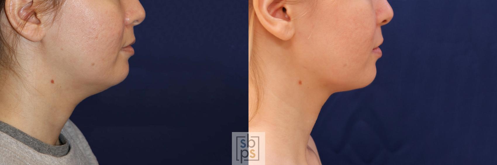 Before & After Chin Liposuction Case 548 Right Side View in Torrance & Los Angeles, CA, CA