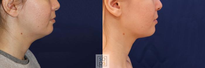 Before & After Chin Liposuction Case 548 Right Side View in Torrance, CA