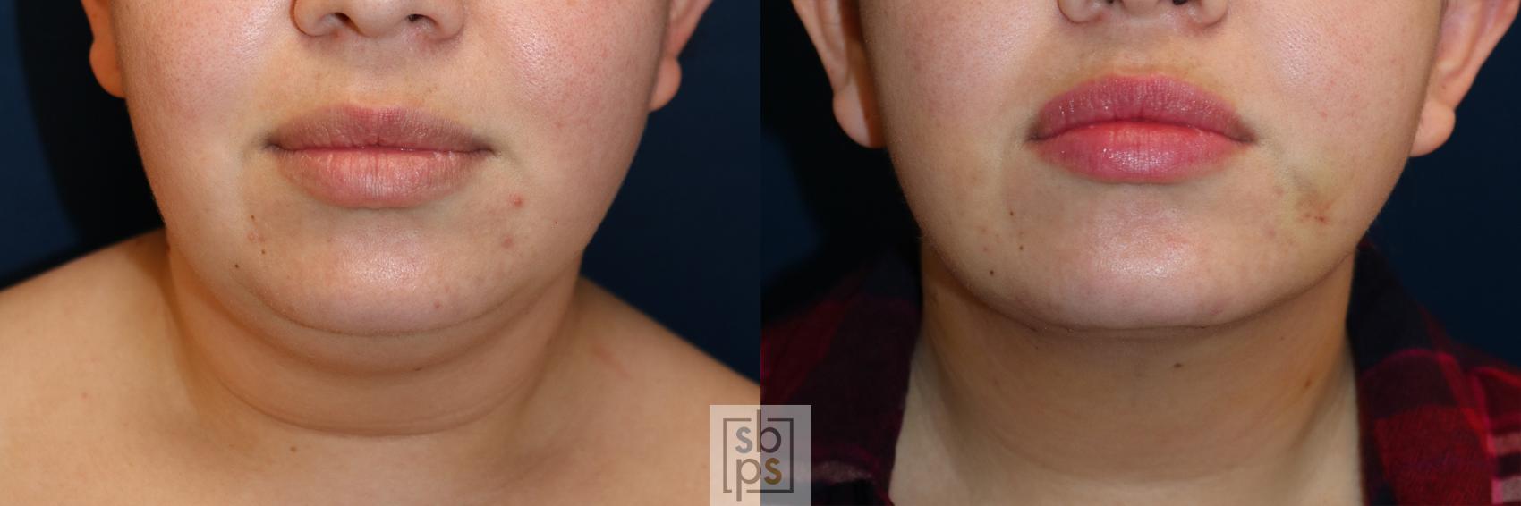 Before & After Chin Liposuction Case 599 Front View in Torrance, CA