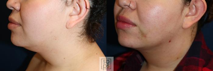 Before & After Chin Liposuction Case 599 Left Oblique View in Torrance, CA