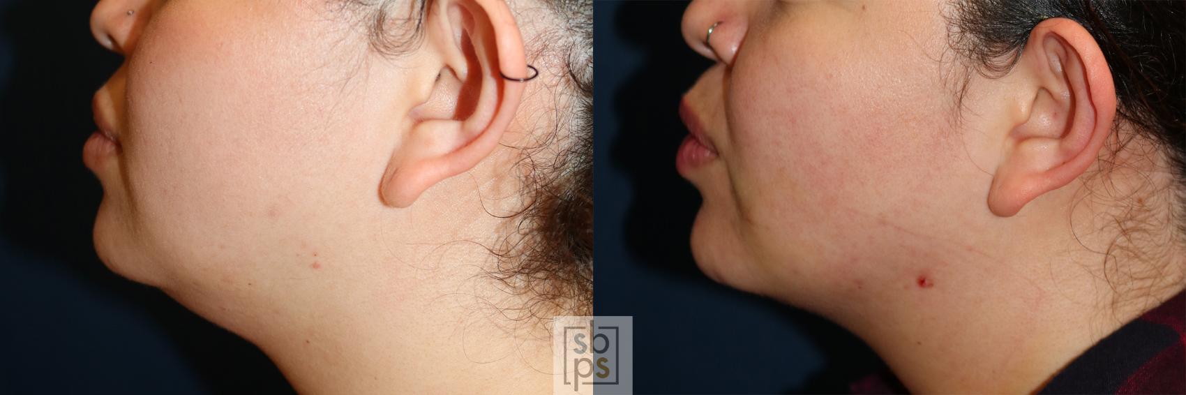 Before & After Chin Liposuction Case 599 Left Side View in Torrance & Los Angeles, CA, CA