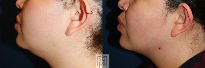 Before & After Chin Liposuction Case 599 Left Side View in Torrance, CA