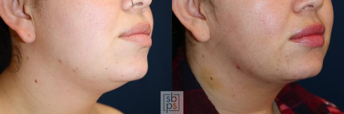 Before & After Chin Liposuction Case 599 Right Oblique View in Torrance, CA