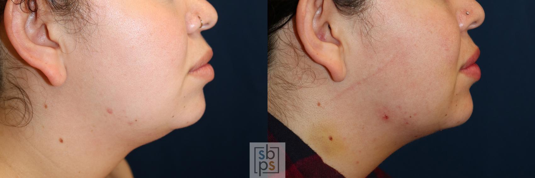 Before & After Chin Liposuction Case 599 Right Side View in Torrance & Los Angeles, CA, CA