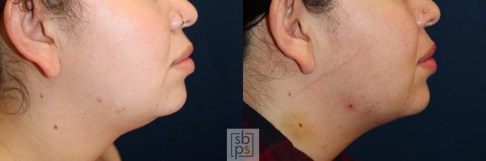 Before & After Chin Liposuction Case 599 Right Side View in Torrance, CA