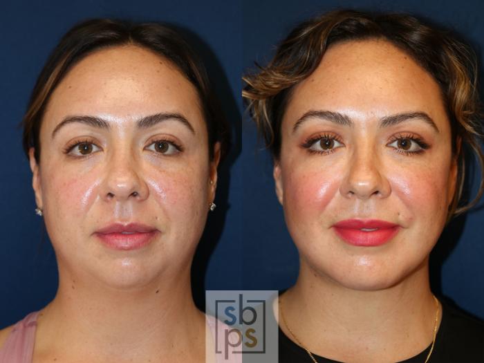 Before & After Chin Liposuction Case 631 Front View in Torrance, CA
