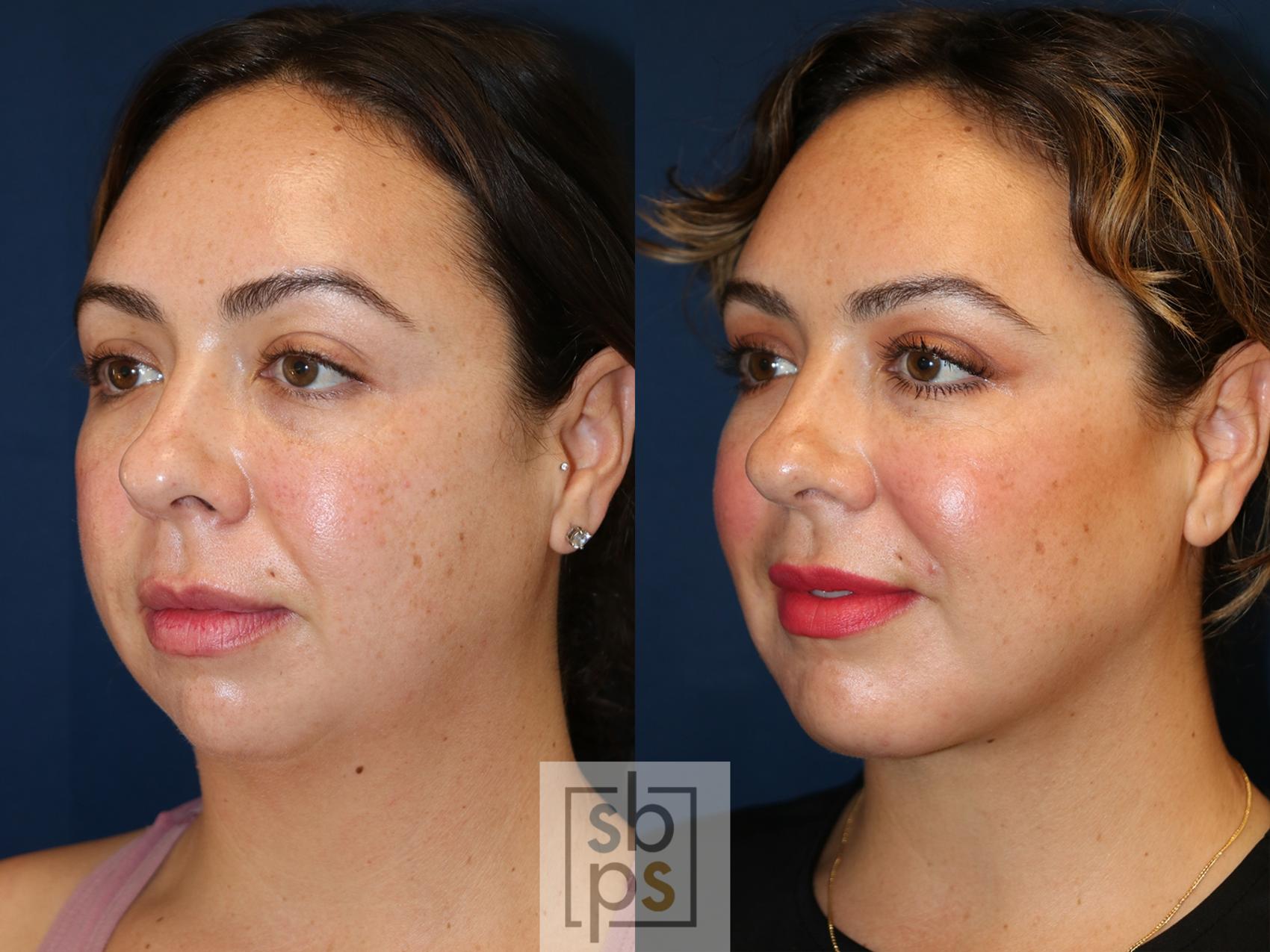 Before & After Chin Liposuction Case 631 Left Oblique View in Torrance & Los Angeles, CA, CA