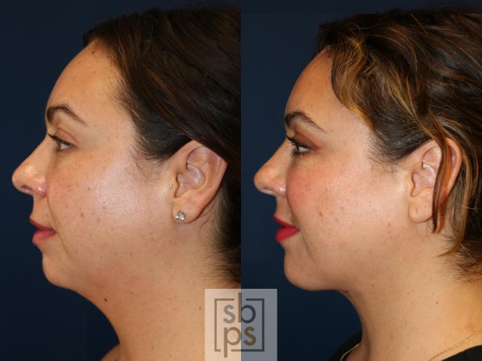 Before & After Chin Liposuction Case 631 Left Side View in Torrance, CA