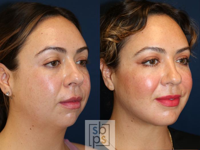 Before & After Chin Liposuction Case 631 Right Oblique View in Torrance, CA