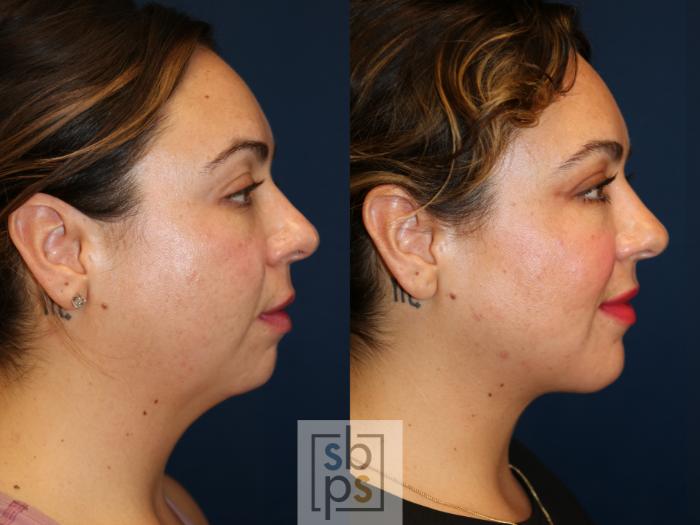 Before & After Chin Liposuction Case 631 Right Side View in Torrance, CA