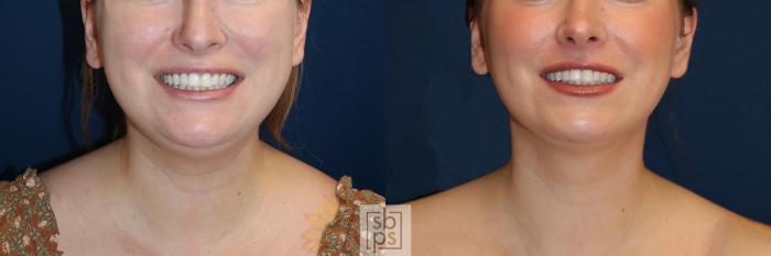 Before & After Chin Liposuction Case 644 Front View in Torrance, CA