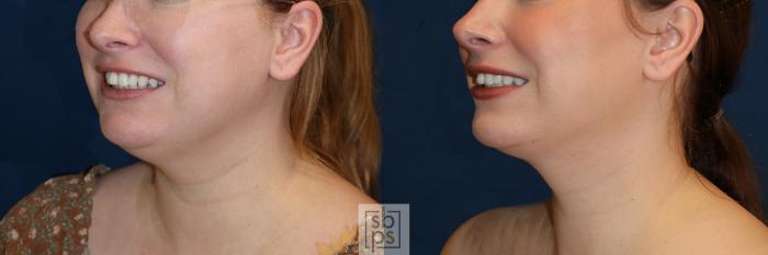 Before & After Chin Liposuction Case 644 Left Oblique View in Torrance, CA