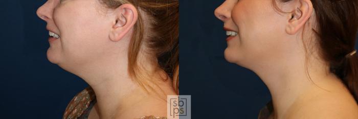 Before & After Chin Liposuction Case 644 Left Side View in Torrance, CA