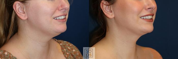 Before & After Chin Liposuction Case 644 Right Oblique View in Torrance, CA