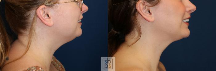 Before & After Chin Liposuction Case 644 Right Side View in Torrance, CA
