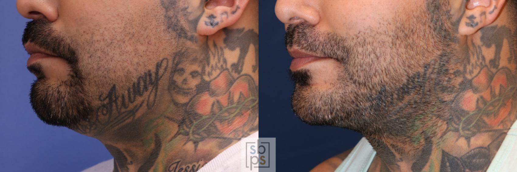 Before & After Chin Liposuction Case 700 Left Oblique View in Torrance & Los Angeles, CA, CA