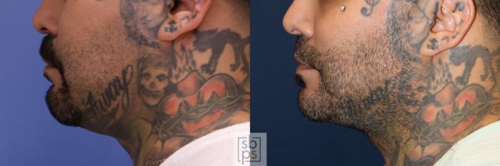 Before & After Chin Liposuction Case 700 Left Side View in Los Angeles & Torrance, CA, CA