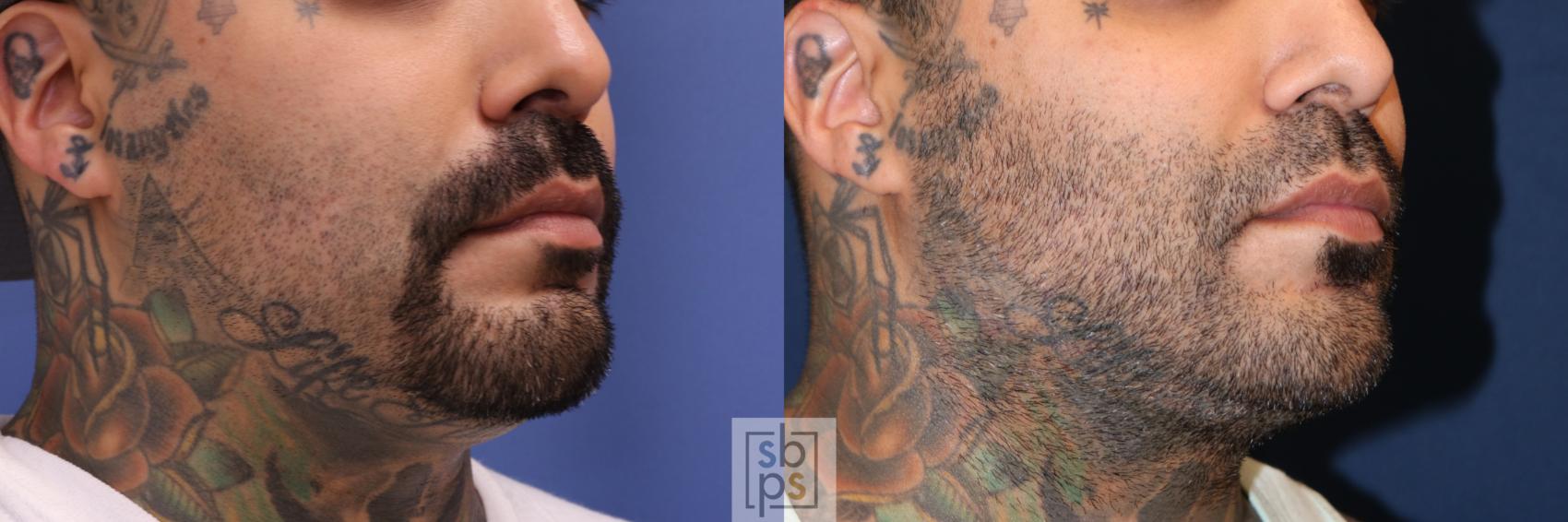 Before & After Chin Liposuction Case 700 Right Oblique View in Torrance & Los Angeles, CA, CA