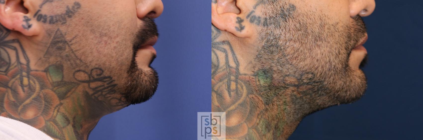 Before & After Chin Liposuction Case 700 Right Side View in Torrance & Los Angeles, CA, CA