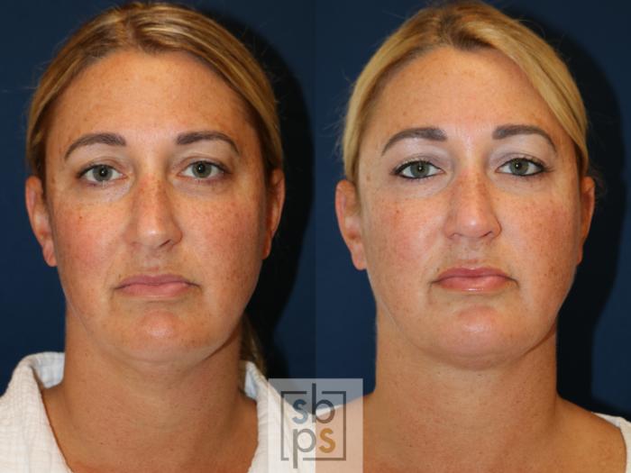 Before & After Chin Liposuction Case 724 Front View in Los Angeles & Torrance, CA, CA