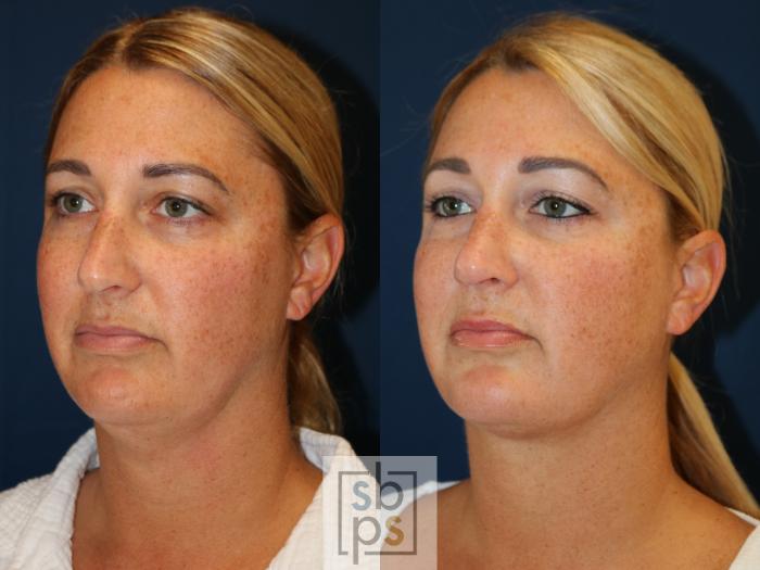 Before & After Chin Liposuction Case 724 Left Oblique View in Los Angeles & Torrance, CA, CA