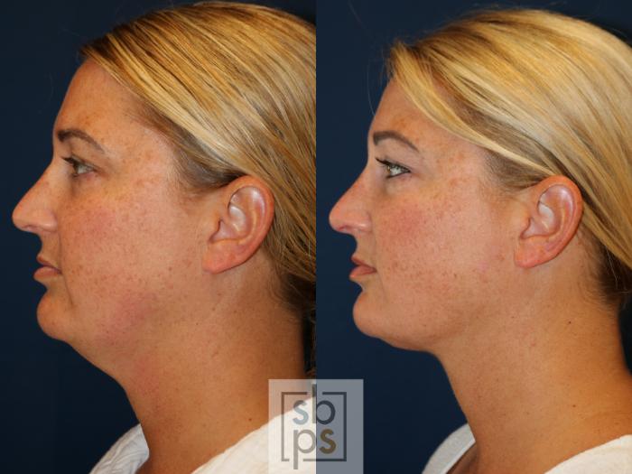 Before & After Chin Liposuction Case 724 Left Side View in Los Angeles & Torrance, CA, CA