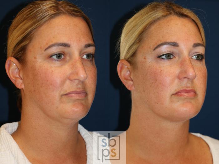 Before & After Chin Liposuction Case 724 Right Oblique View in Los Angeles & Torrance, CA, CA