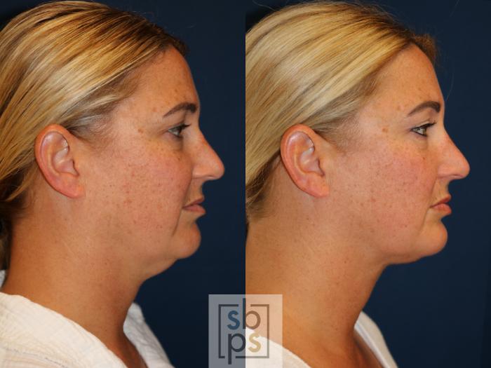 Before & After Chin Liposuction Case 724 Right Side View in Los Angeles & Torrance, CA, CA