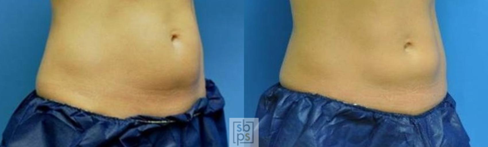 Before & After CoolSculpting Case 137 View #1 View in Torrance, CA