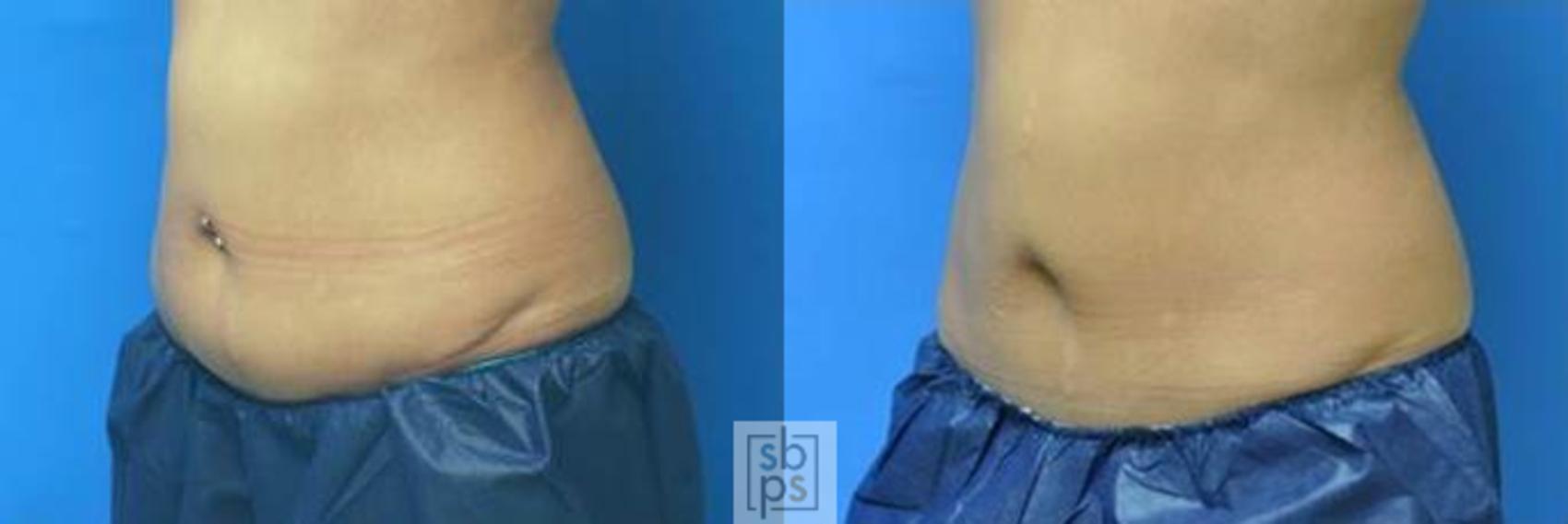 Before & After CoolSculpting Case 138 View #2 View in Torrance & Los Angeles, CA, CA