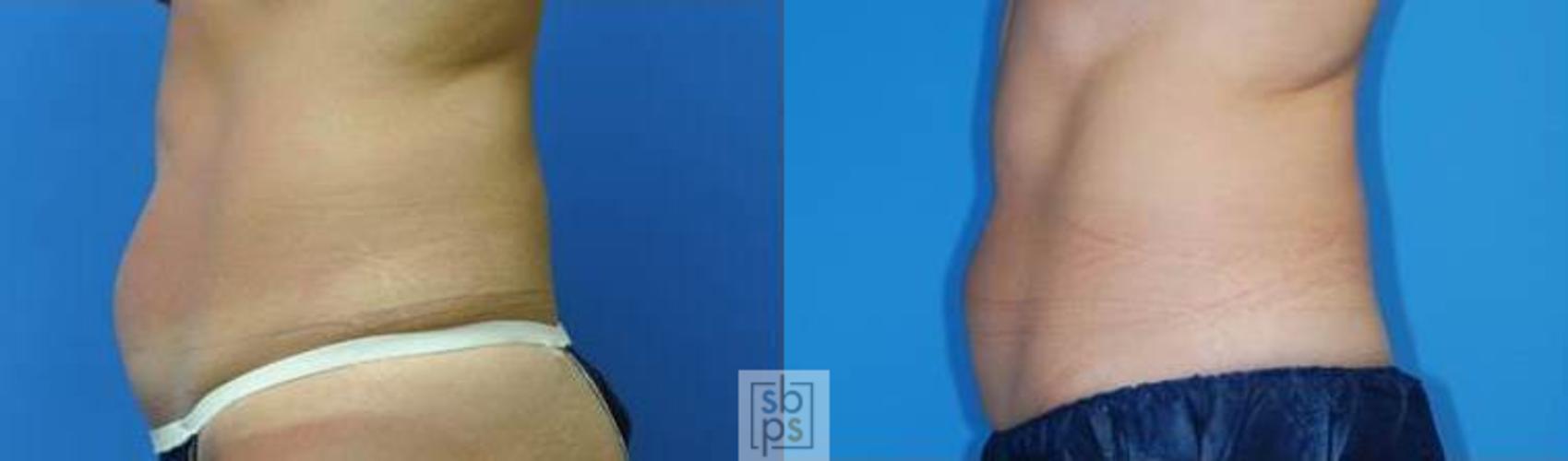 Before & After CoolSculpting Case 139 View #1 View in Torrance, CA